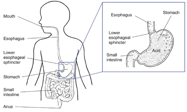 Drawing of the digestive tract within an outline of the top half of a child’s body. Inset shows a cross section of the stomach.