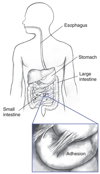 Drawing of the GI tract showing the esophagus, stomach, and large intestine. Inset shows abdominal adhesions on the small intestine, also labeled.