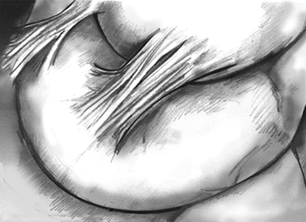 Drawing of abdominal adhesions on the small intestine.
