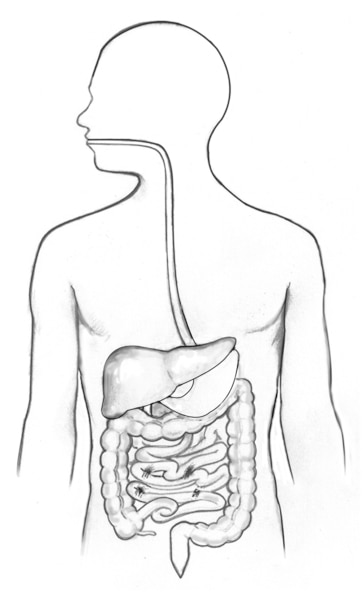 Drawing of the gastrointestinal tract showing the esophagus, stomach, and large intestine.