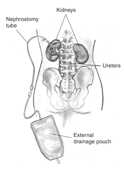 Drawing of the kidneys, nephrostomy tube, and urine collection bag. The curled end of the nephrostomy tube is within the left kidney.