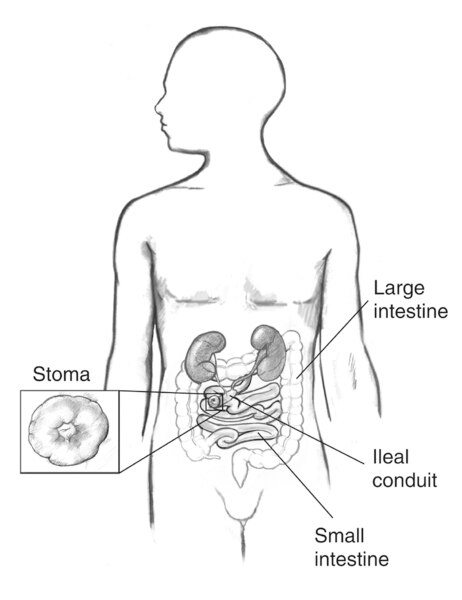 Drawing of an ileal conduit diversion, with stoma enlarged in inset box. Labels point to a stoma, large intestine, ileal conduit, and small intestine.