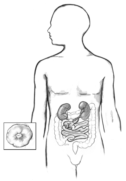 Drawing of an ileal conduit diversion, with stoma enlarged in inset box.