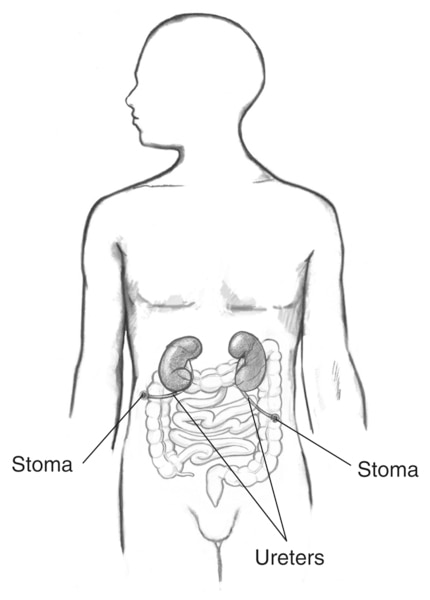 Drawing of a cutaneous ureterostomy. Labels point to two stomas and two ureters.