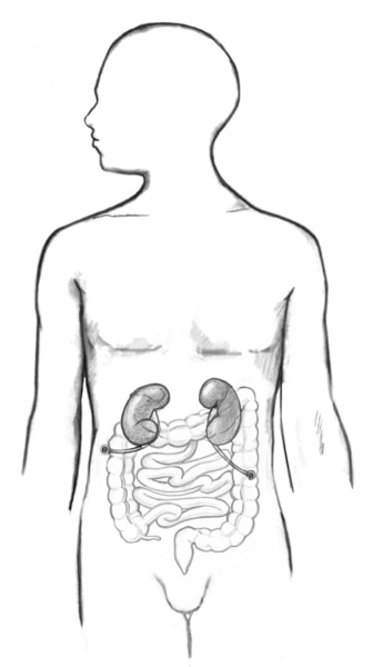 Drawing of a cutaneous ureterostomy.