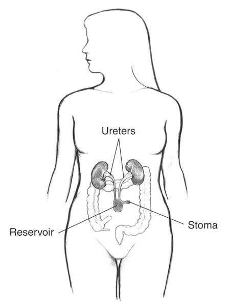 Drawing of a continent cutaneous reservoir. Labels point to the reservoir, two ureters, and a stoma.