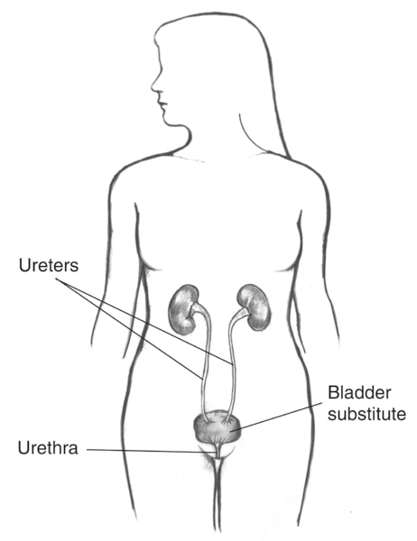 Drawing of a bladder substitute. Labels point to two ureters, bladder substitute, and urethra.