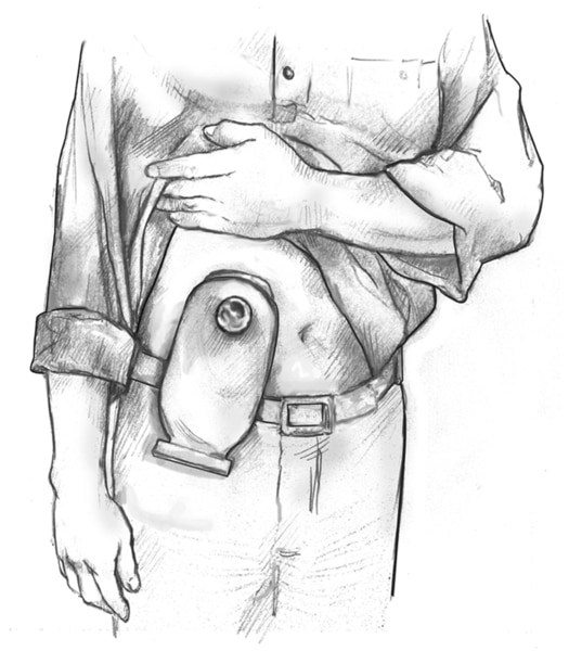 Drawing of a man holding up his shirt to show a urostomy pouch attached to his abdomen.