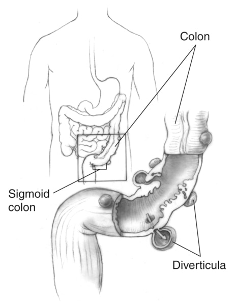 Drawing of the colon and an enlargement of it showing diverticula.