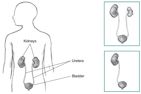 Drawing of urinary tract in an outline of the top half of a human body. Inset of one kidney and the bladder and one kidney, nonworking kidney, and the bladder.