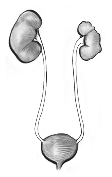 Drawing of one kidney, nonworking kidney, and the bladder.