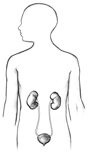 Drawing of urinary tract with kidney stones.