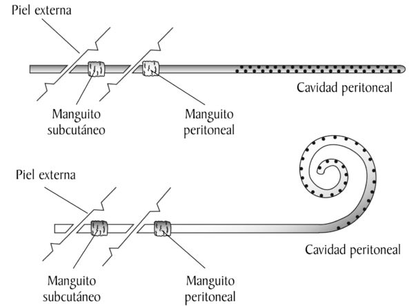 Spanish labels. Dibujo de dos catéteres Tenckhoff que se usan en diálisis peritoneal, etiquetados.