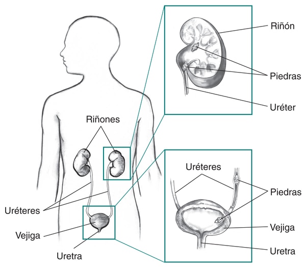 Ilustración de las vías urinarias con rótulos para los riñones, vejiga, uréteres y uretra. El recuadro muestra cortes transversales de un riñón y la vejiga con piedras.