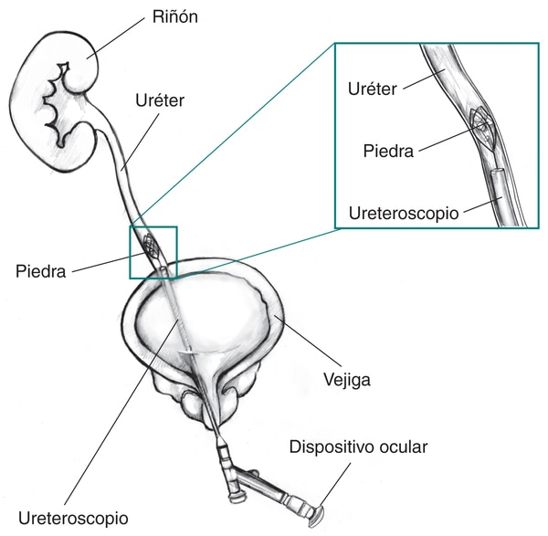 Ilustración de la vejiga, uréter y riñón con un corte transversal del ureteroscopio insertado por la vejiga en el uréter, donde una piedra obstruye el flujo de orina.