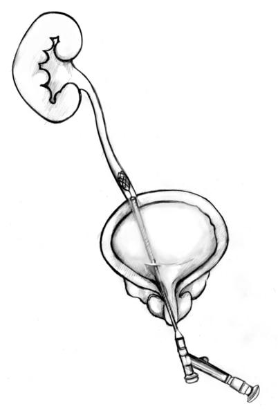 Dibujo de la vejiga, el uréter y el riñón con una sección transversal de un ureteroscopio insertado a través de la vejiga al uréter, donde un flujo de orina bloques de piedra.