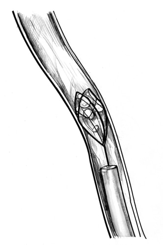 Dibujo del uréter que muestra una cesta de alambre en el extremo de la ureteroscopio la captura de la piedra.