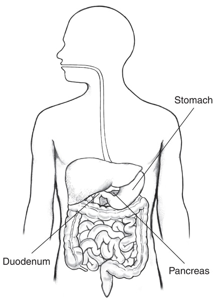 Drawing of the digestive tract within an outline of the top half of a human body. The stomach, pancreas, and duodenum are labeled.