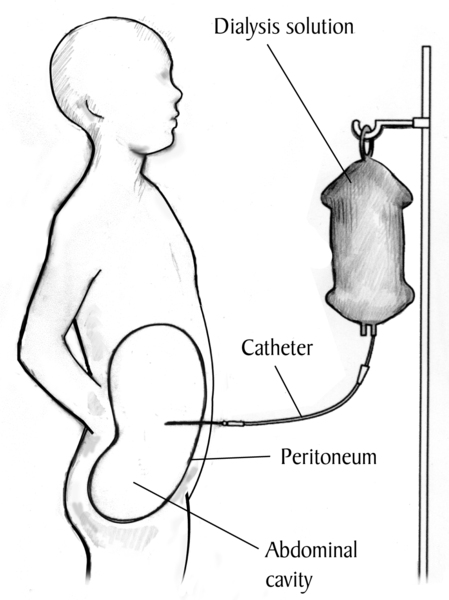 Drawing of a child receiving peritoneal dialysis treatment. Labels point to the dialysis solution, catheter, peritoneum, and abdominal cavity.