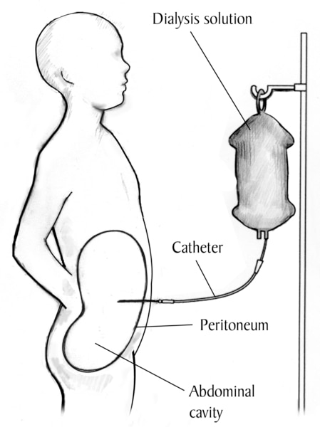 Drawing of a child receiving peritoneal dialysis treatment. Labels point to the dialysis solution, catheter, peritoneum, and abdominal cavity.