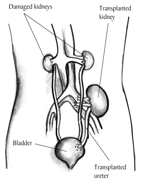 Drawing of a transplanted kidney inside an outline of the abdomen. The two damaged kidneys are still in place on either side of the spine, just below the rib cage. The transplanted kidney is located on the left side, just above the bladder. A transplanted