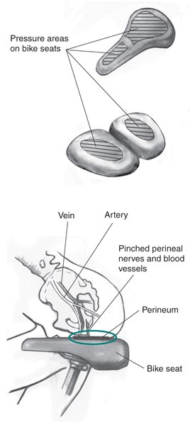 Drawing of two bike seats, with and without a nose. Side-outline view of a person sitting on a bike seat, with pinched perineal nerves and blood vessels labeled.