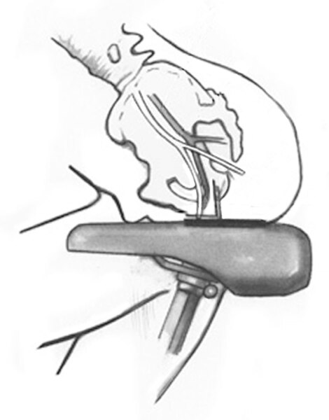 Side-outline view of a person sitting on a bike seat, with pinched perineal nerves and blood vessels.