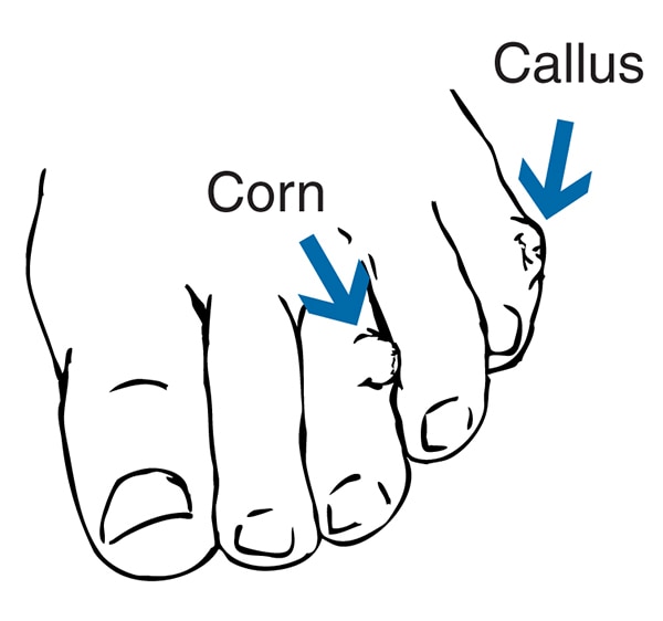 Drawing of a foot with a corn and a callus.