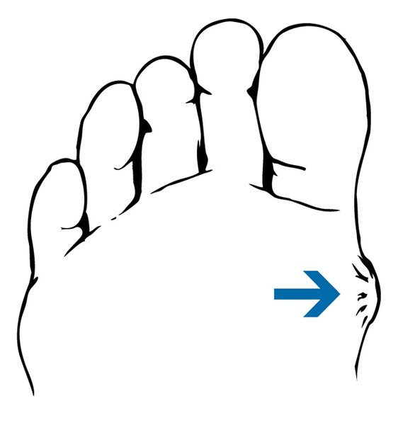 Drawing of a foot with a blister.