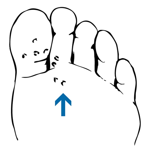 Drawing of a foot with plantar warts.