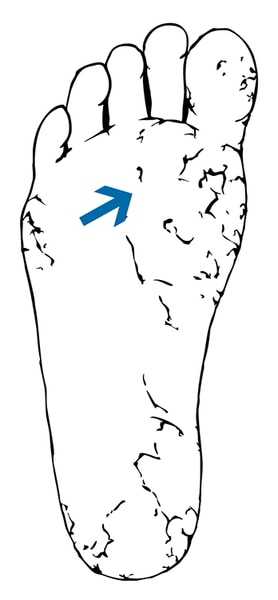 Drawing of a foot with dry and cracked skin.