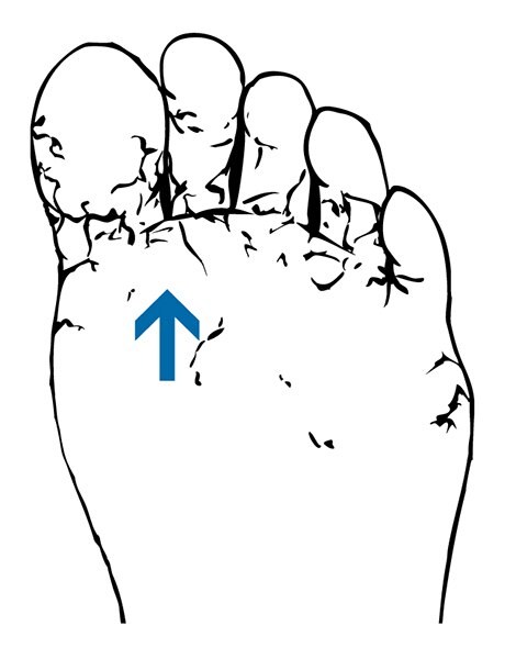 Drawing of a foot with athlete's foot.