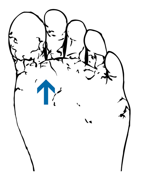 Drawing of a foot with athlete's foot.