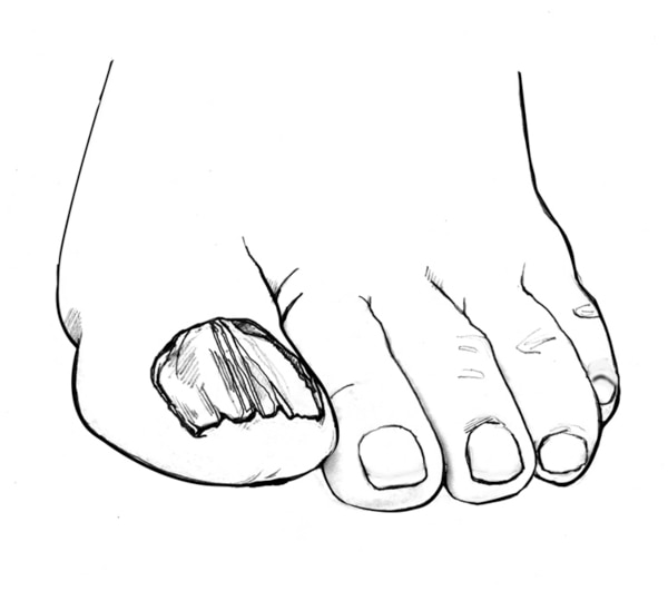 Drawing of a foot with a fungal infection on a toenail.