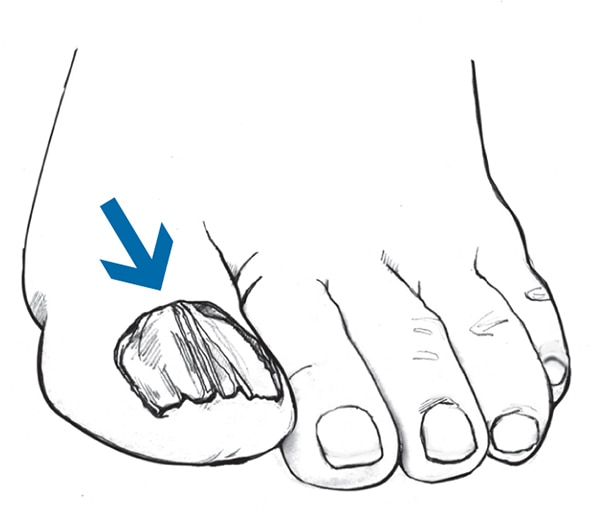 Drawing of a foot with a fungal infection on a toenail.