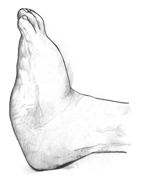 Drawing of a large, swollen foot.