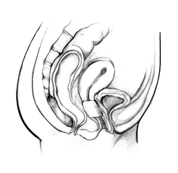 Drawing of a woman’s pelvic area with the vagina, bladder, and an inserted pessary.