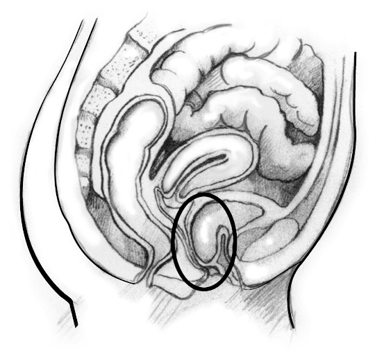 Drawing of a woman’s pelvic area.
