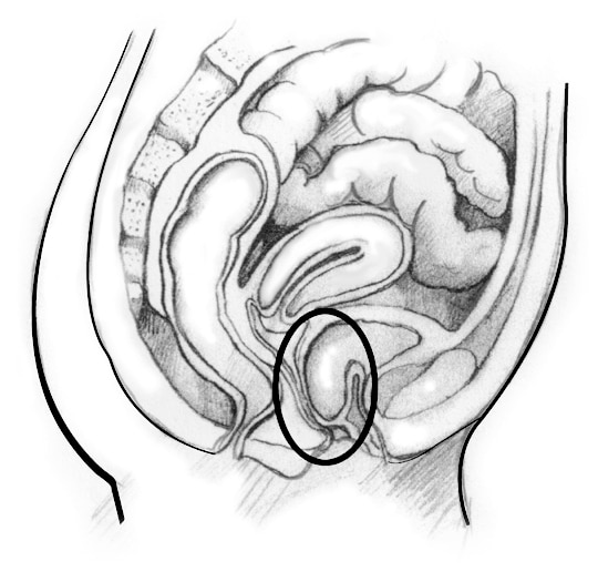 Drawing of a woman’s pelvic area.