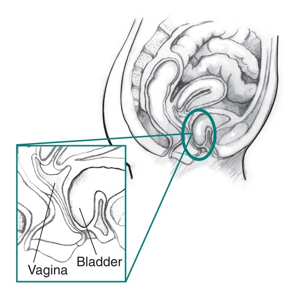 Drawing of a woman’s pelvic area with an inset enlargement of the vagina, bladder, and cystocele labeled.