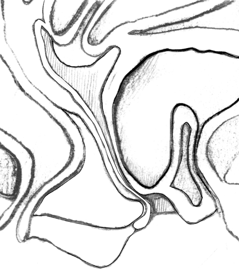 Drawing of the vagina, bladder, and cystocele.