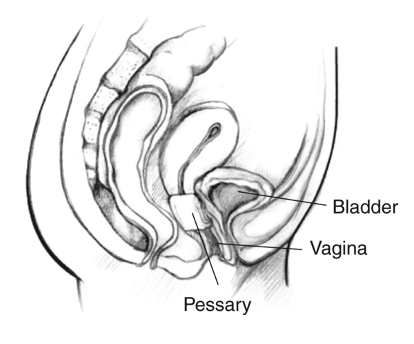 Drawing of a woman’s pelvic area with the vagina, bladder, and an inserted pessary labeled.