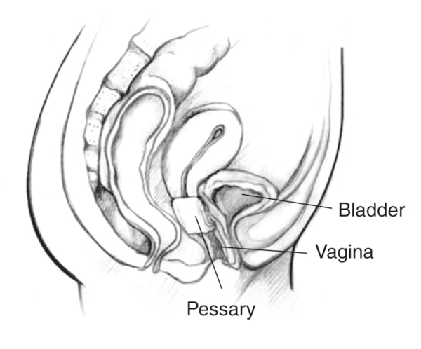 Drawing of a woman’s pelvic area with the vagina, bladder, and an inserted pessary labeled.