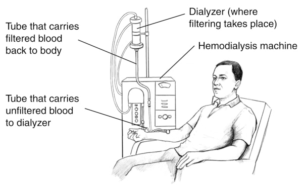 Drawing of a man receiving hemodialysis treatment. Labels point to the dialyzer, where filtering takes place; hemodialysis machine; a tube that carries filtered blood back to body and tube that carries unfiltered blood to dialyzer.
