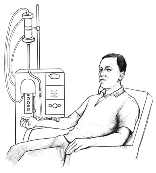 Drawing of a man receiving hemodialysis treatment.