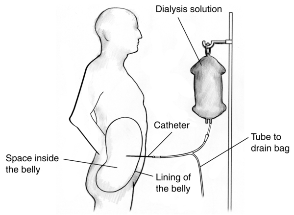 Outline of a male figure receiving peritoneal dialysis. Labels point to the dialysis solution, catheter, space inside the belly, lining of the belly and tube to drain bag.