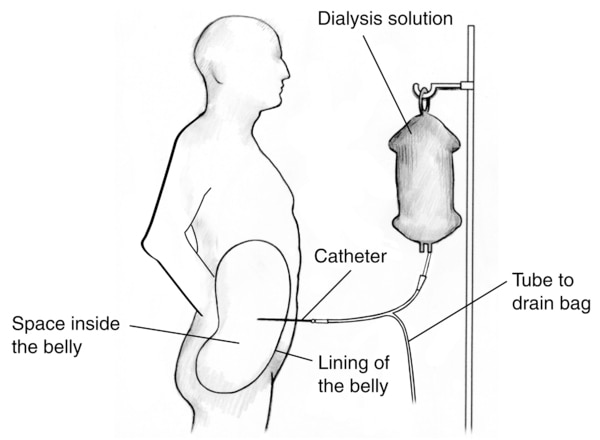 Outline of a male figure receiving peritoneal dialysis. Labels point to the dialysis solution, catheter, space inside the belly, lining of the belly and tube to drain bag.