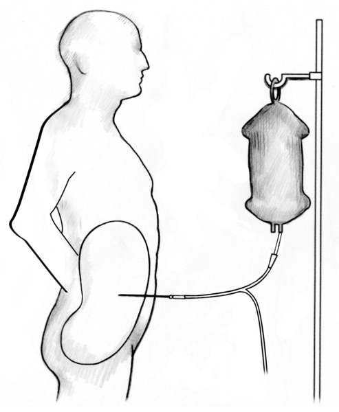 Outline of a male figure receiving peritoneal dialysis.