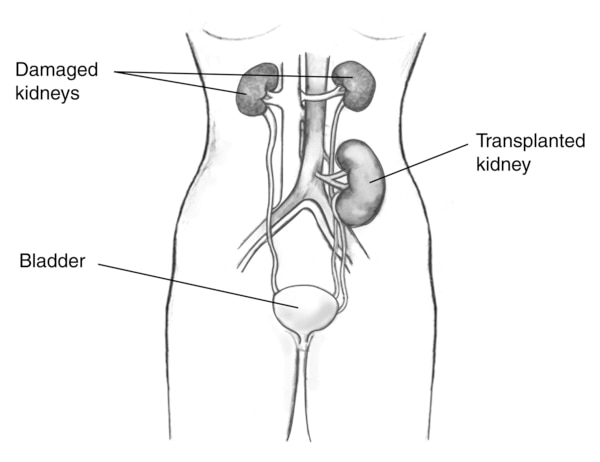 Outline of a female figure with a transplanted kidney. Labels point to bladder, transplanted kidney and damaged kidney.