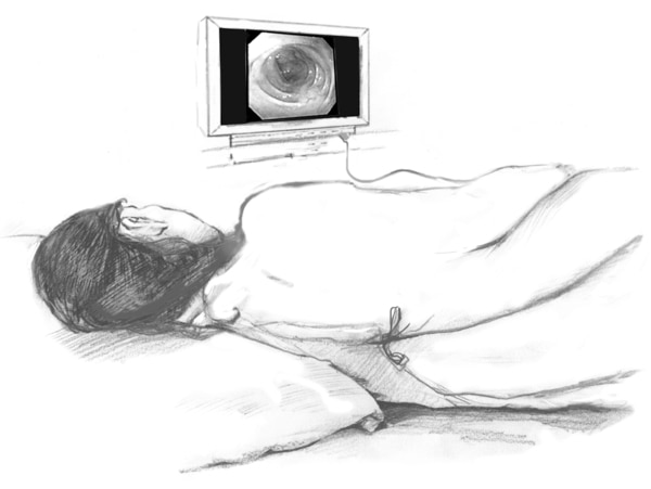 Drawing of a female patient lying on a table with an inserted sigmoidoscope projecting an image onto a computer screen.